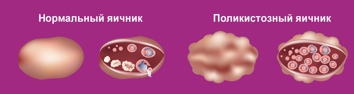 Синдром поликистоза яичников симптомы. ПКЯ – поликистозные яичники. Инсулинорезистентность и поликистоз яичников.